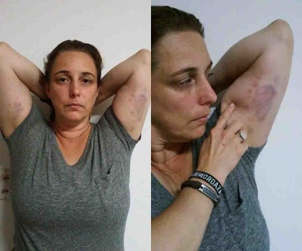 tania-bruises